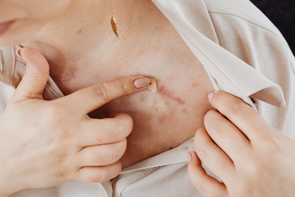 The Future of Scar Healing: How Beauty Tech Is Revolutionizing Scar Management