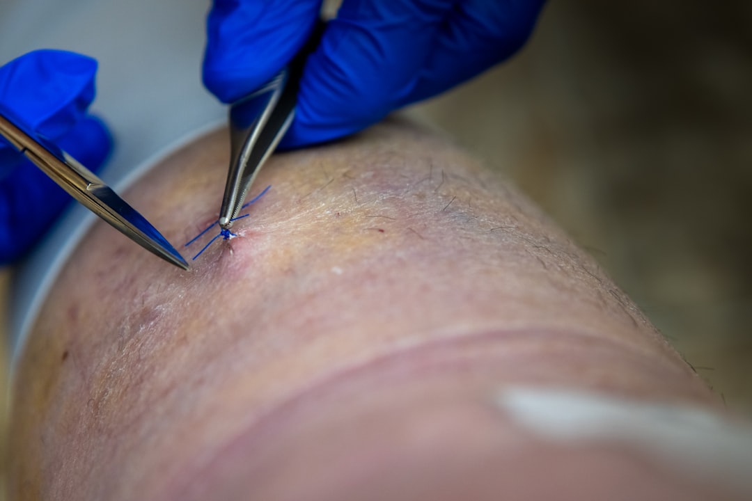 The Eczema Breakthrough: Why Microneedling and PRP Are Revolutionizing Sensitive Skin Care